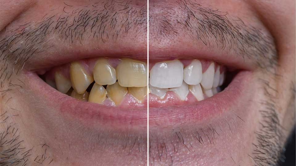 سفید کردن دندان های زرد