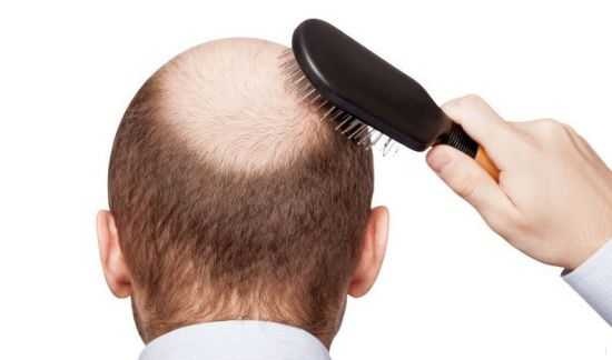 درمان قطعی ریزش مو توسط طب سنتی