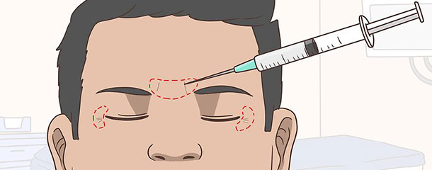 چروک زیر چشم در جوانی : اثر بوتاکس در درمان چروک زیر چشم