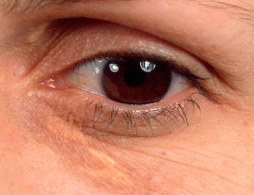 چگونه افتادگى پلک چشم را درمان کنیم؟ +نظر متخصص