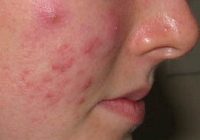 علائم آکنه در نوجوانان چگونه است؟