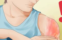چگونه آفتاب سوختگی را درمان کنیم؟