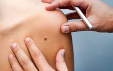 خال پوستی چه زمانی سرطانی می شود؟ +علائم و نشانه ها