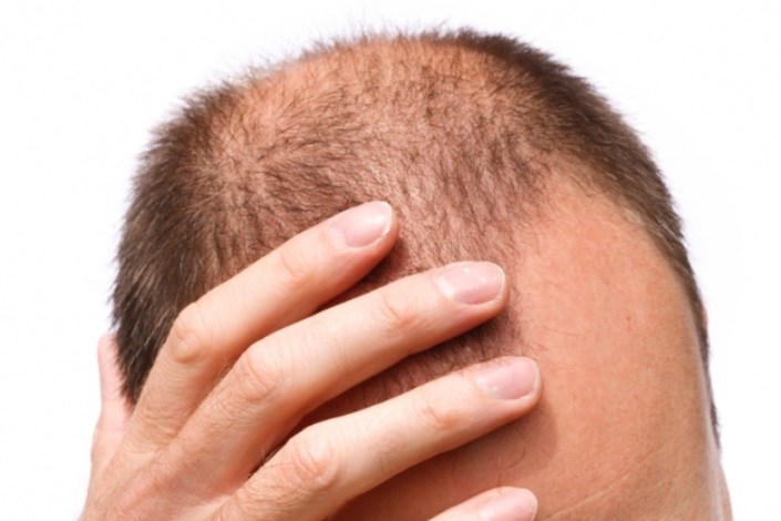 آیا داروی آرتروز به رشد موهای جدید کمک می کند؟!