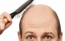 راهکار تعویق طاسی آقایان