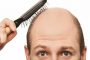 ۶ راه درمان خانگی ریزش شدید موی سر