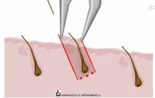 همه چیز در مورد کاشت مو