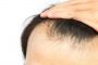 همه آنچه درباره ریزش موی مردان باید بدانیم