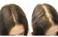 درمان‌های طبیعی برای ریزش مو و رشد مو