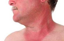 آفتاب سوختگی و درمان های خانگی موثر