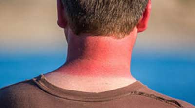 ۱۲ درمان طبیعی آفتاب سوختگی پوست صورت و بدن