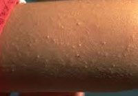 پوستی که شبیه پوست مرغ پرکنده است