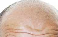 شایع ترن علل ریزش مو در مردان و زنان چیست؟
