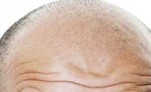 شایع ترن علل ریزش مو در مردان و زنان چیست؟