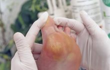 درمان‌های خانگی برای پینه‌های پا